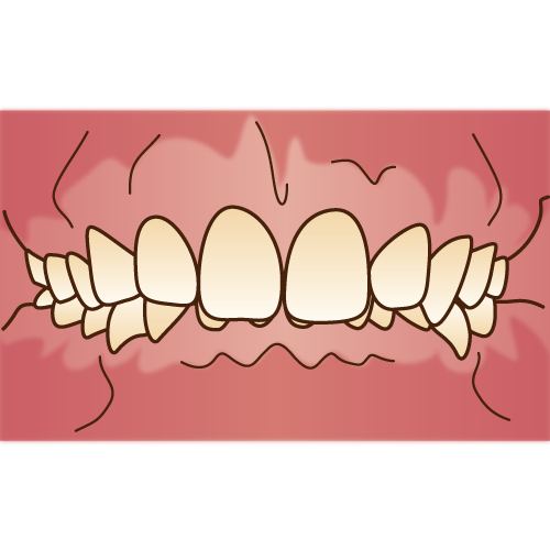 矯正治療の解説イラスト