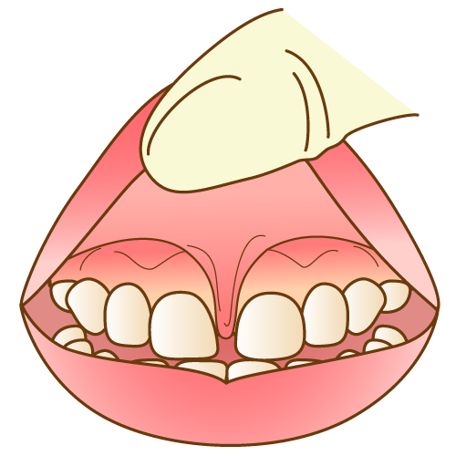 舌癖(低位舌)のイラスト
